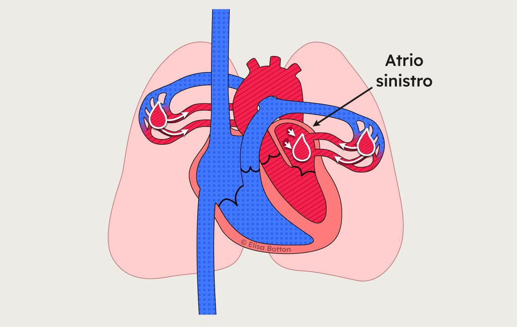 Atrio sinistro del cuore che riceve sangue ossigenato proveniente dai polmoni.