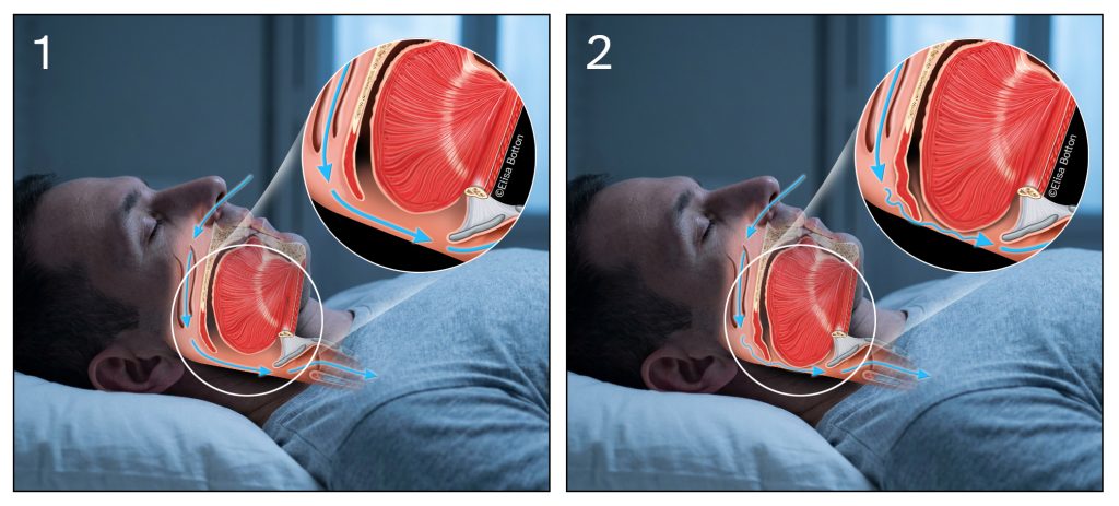 Immagine comparativa di un uomo che dorme in posizione supina con sezione anatomica laterale delle vie aeree superiori. Nella figura 1 la lingua e il palato molle mantengono uno spazio faringeo ampio con flusso d’aria regolare. Nella figura 2 il rilassamento dei tessuti provoca la retroposizione della lingua e il restringimento della gola, con flusso turbolento responsabile del russamento.