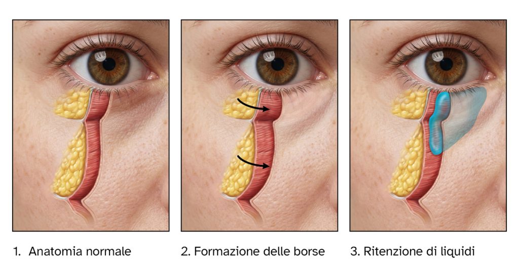 Schema anatomico del contorno occhi che mostra tre situazioni: anatomia normale della palpebra inferiore, formazione delle borse sotto gli occhi dovuta alla protrusione del grasso orbitario e accumulo di liquidi nella palpebra inferiore.
